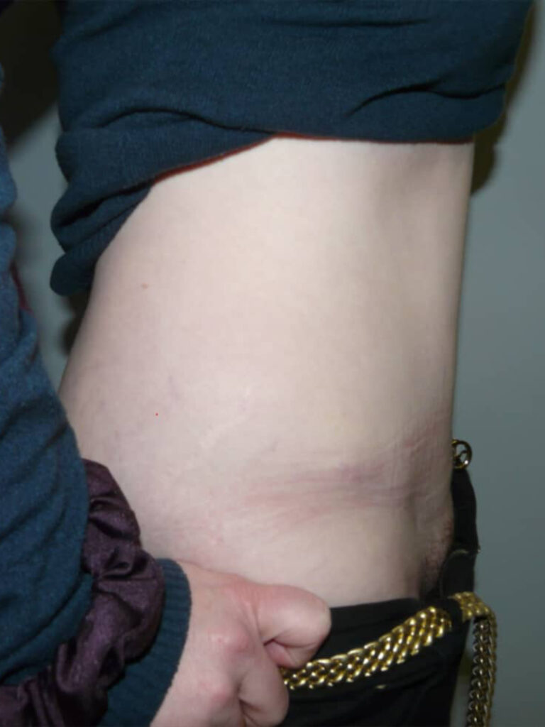 abdominoplastia después