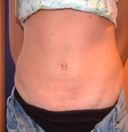 abdominoplastia despues