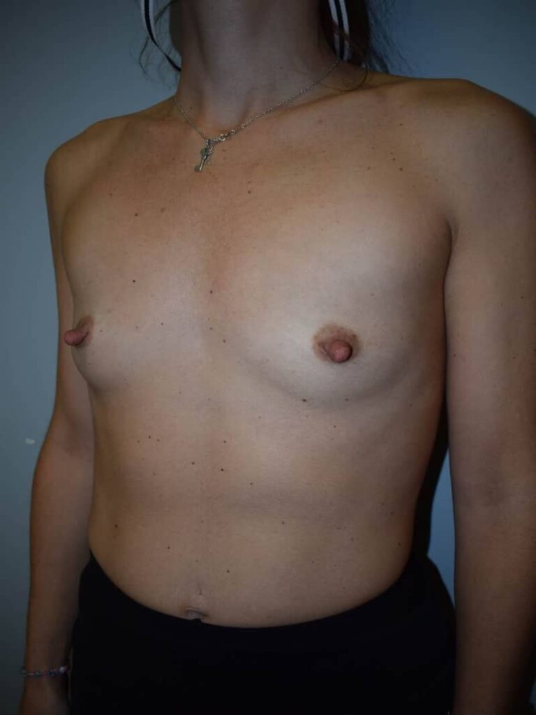 Cirugia aumento mamario antes