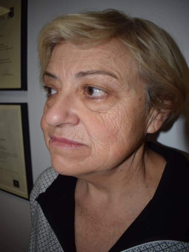 Lifting facial antes