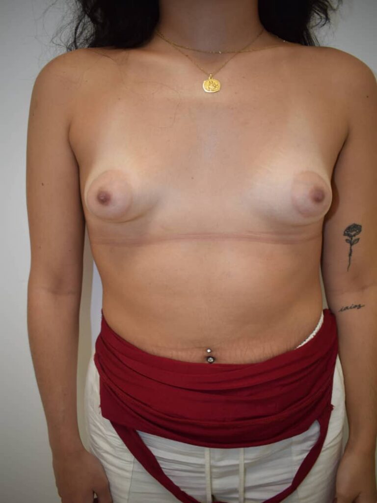 Mamas tuberosas antes