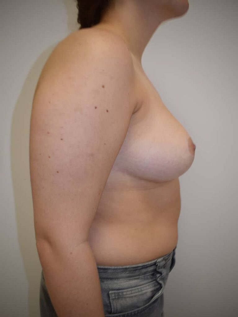 Reduccion mamaria antes cirugia