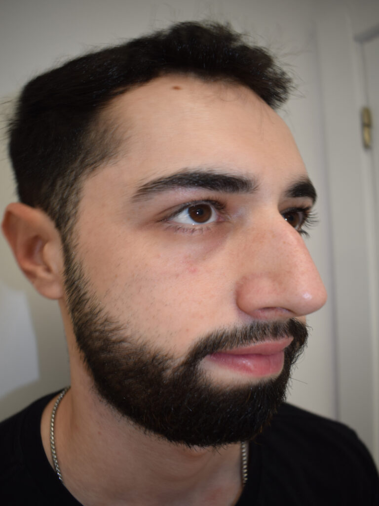 Rinoplastia antes cirugia