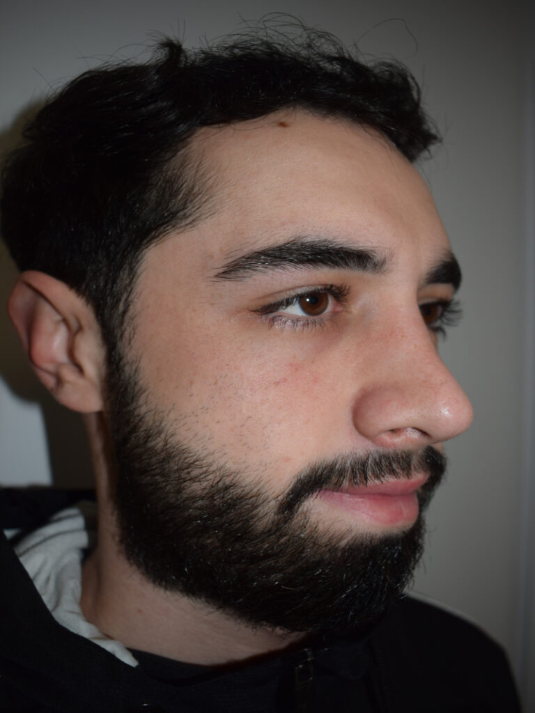 Rinoplastia despues cirugia