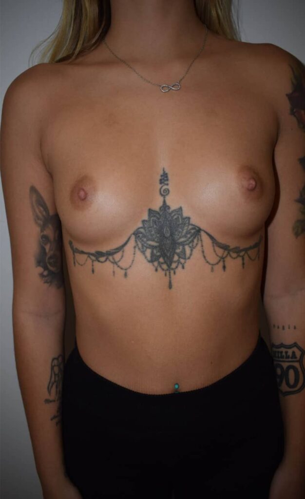 aumento mamario antes