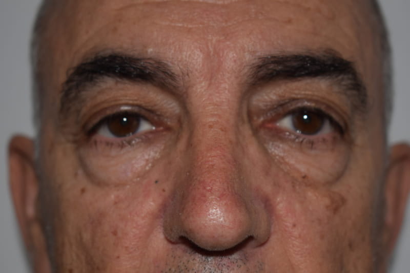 blefaroplastia antes
