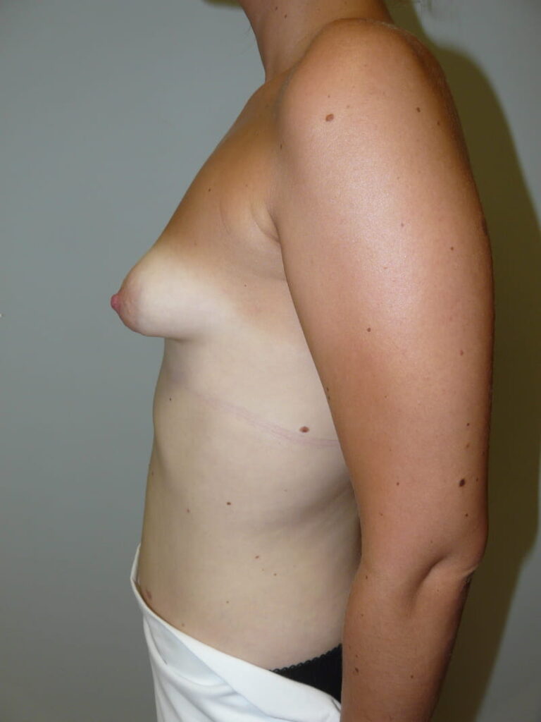 mamas tuberosas antes