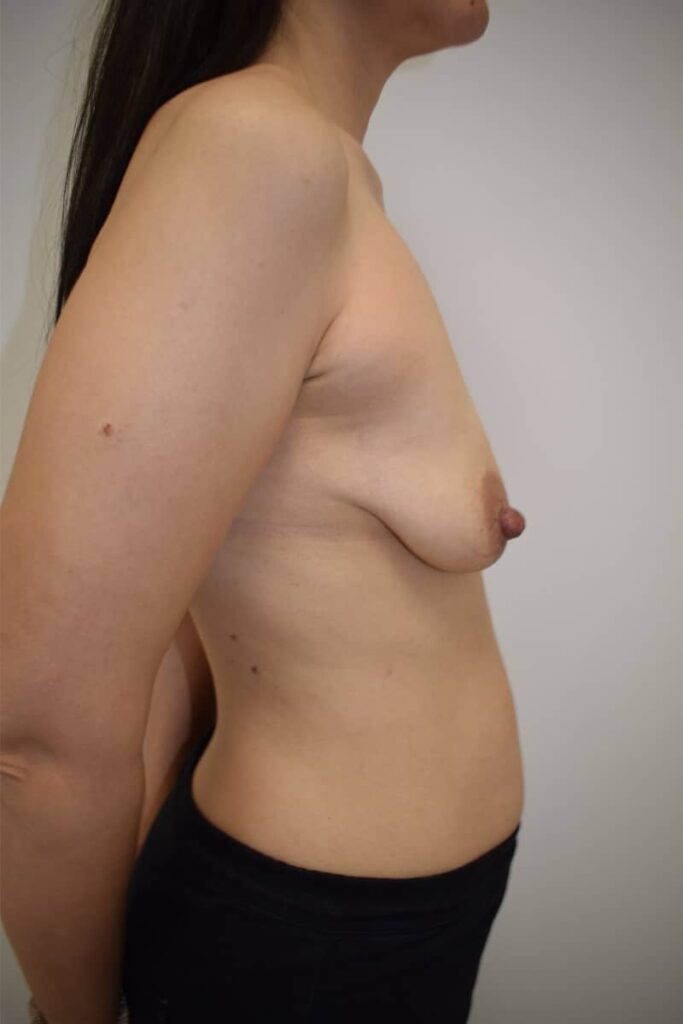 mastopexia con prótesis caso 5 antes