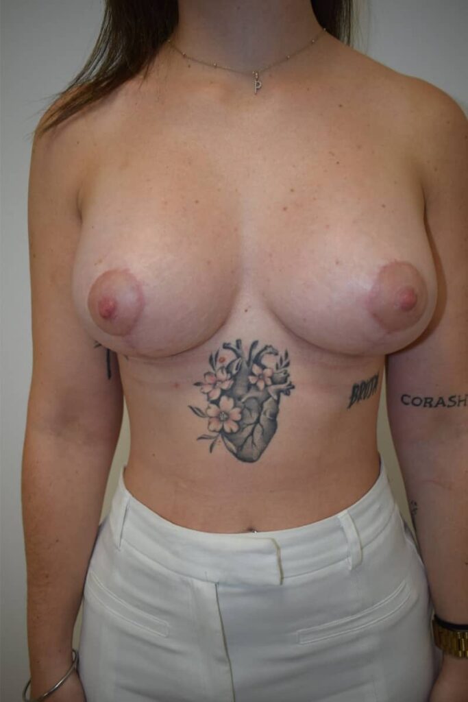 mastopexia con prótesis caso 4 después