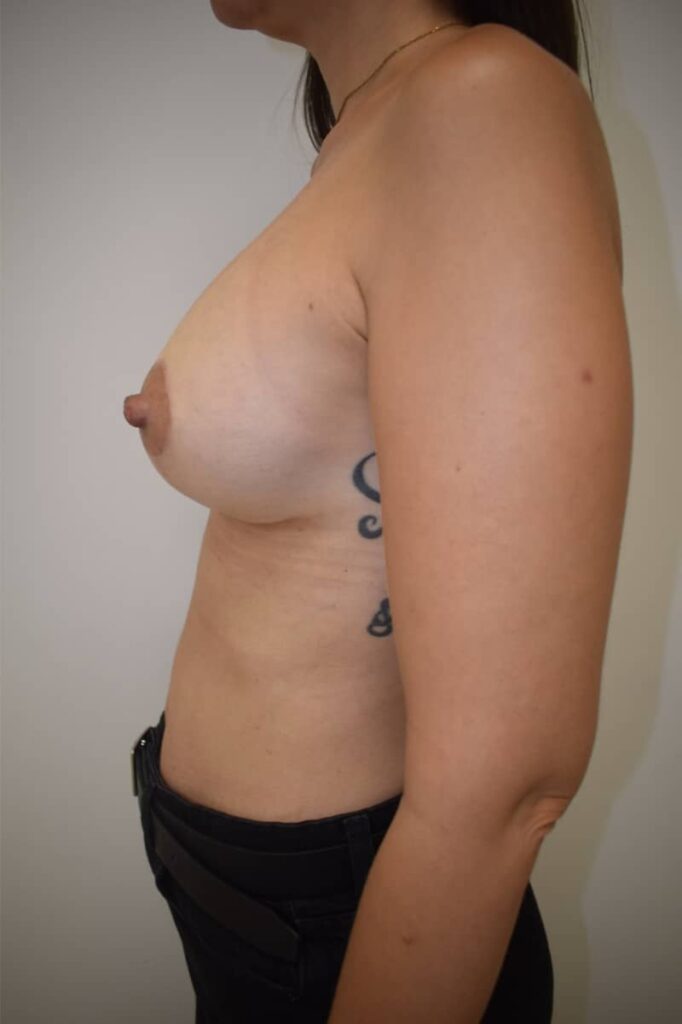 mastopexia con prótesis caso 5 después