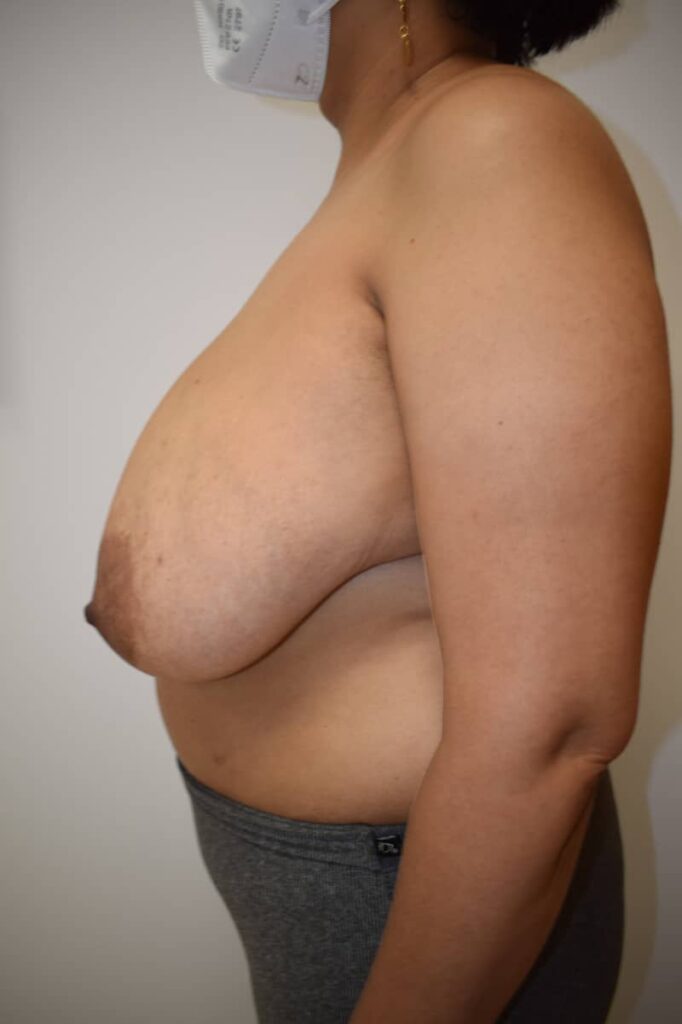 reducción mamaria caso 3 antes