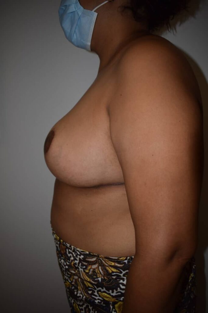 reducción mamaria caso 3 después