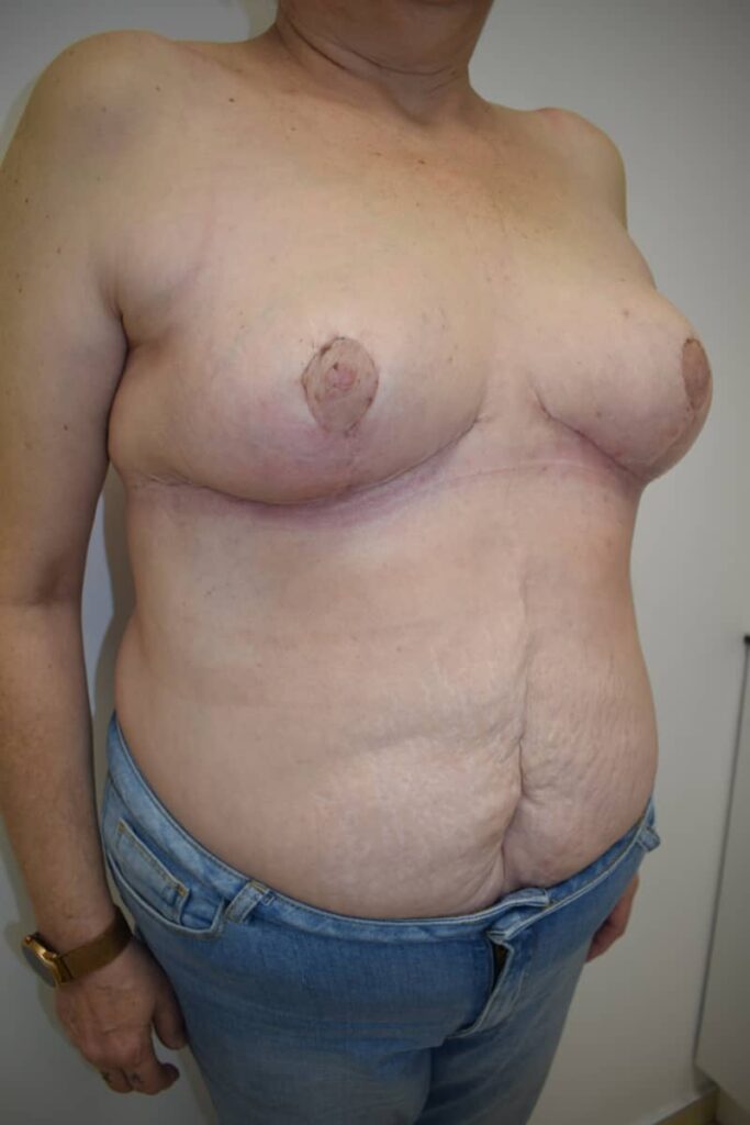 reducción mamaria después caso 4