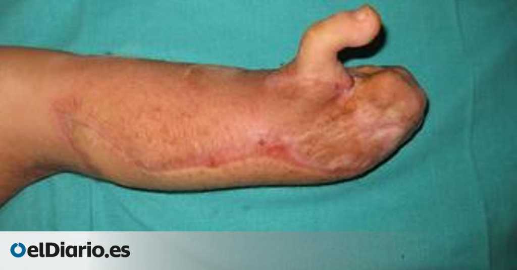 reconstrucción mano