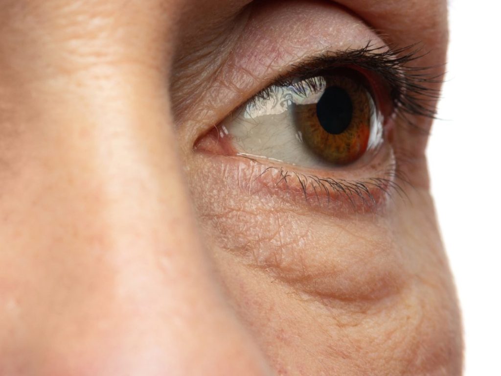 Detalle de bolsa bajo el ojo para artículo sobre blefaroplastia